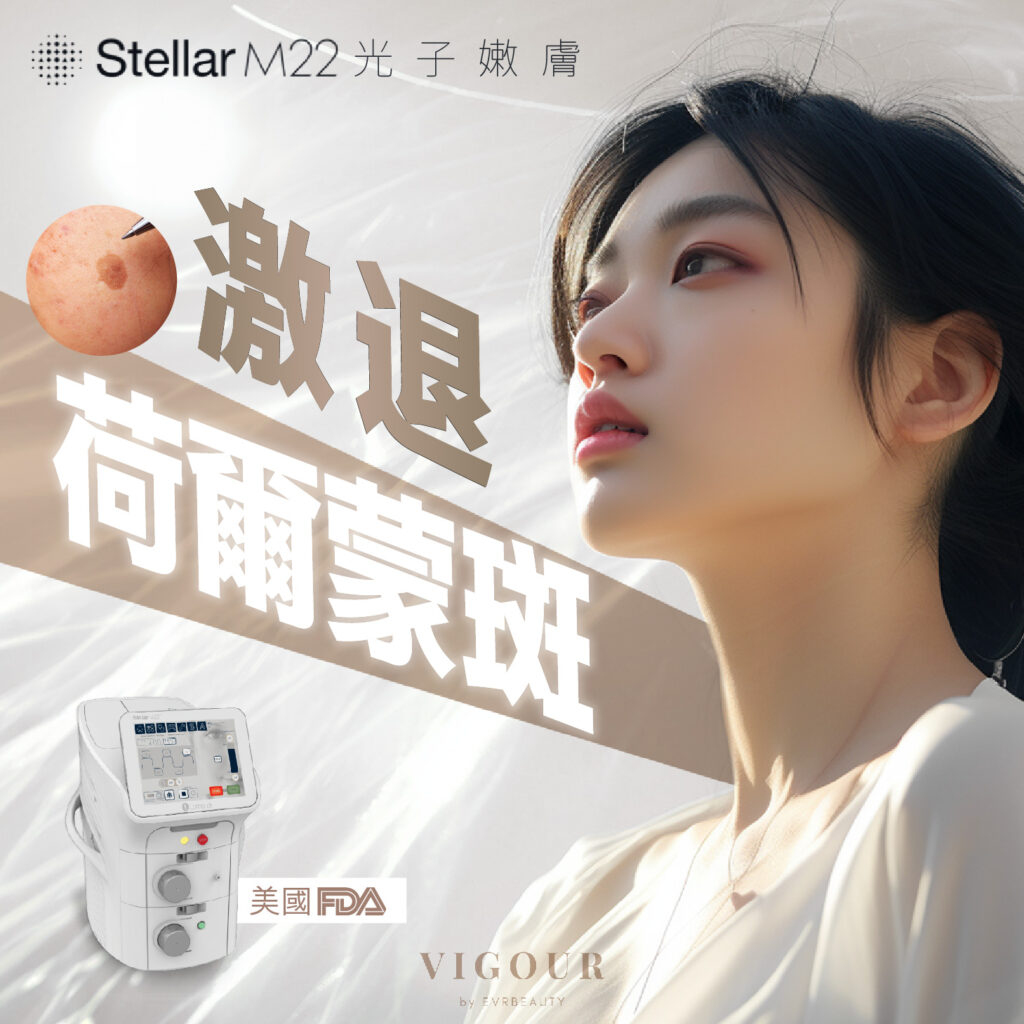 【M22 Stellar 光子嫩膚攻略？】比較Stellar M22與皮秒效果！嫩膚袪斑又如何？不限濾片？附香港價錢