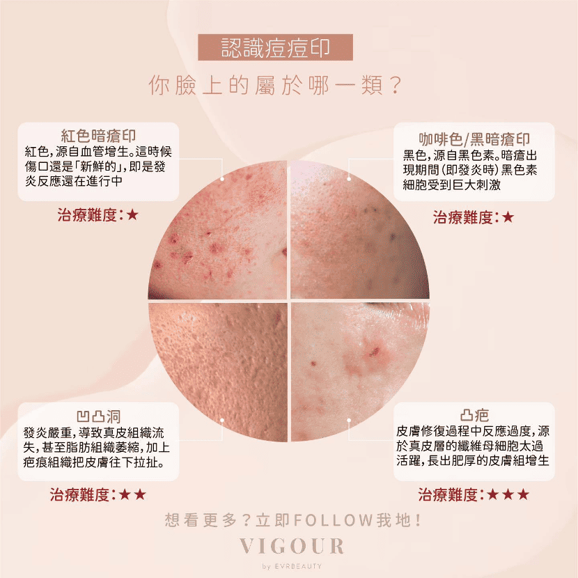 【凹凸洞治療】新一代量膚定制治療：3重夾擊痘疤