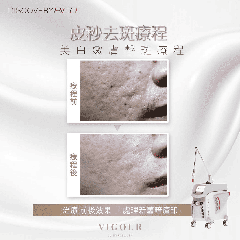 【凹凸洞治療】新一代量膚定制治療：3重夾擊痘疤