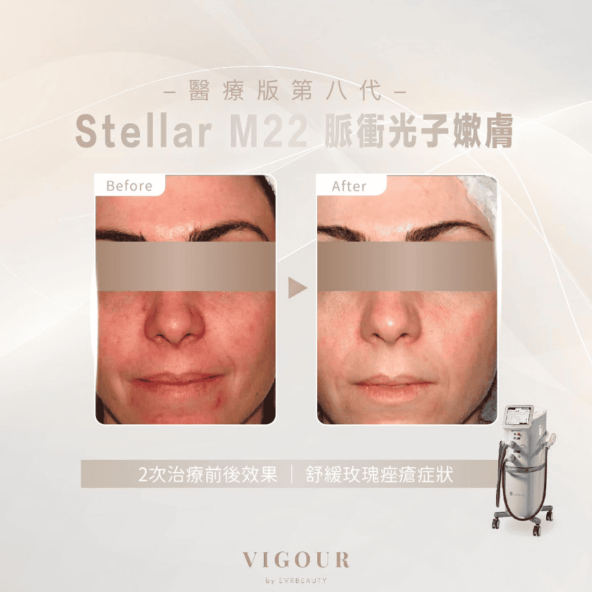 Stellar M22 OPT™治療玫瑰痤瘡