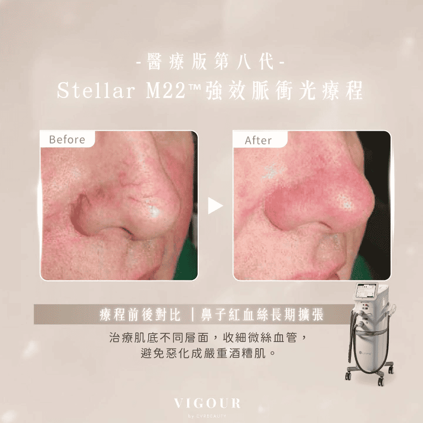 Stellar M22 OPT™治療玫瑰痤瘡