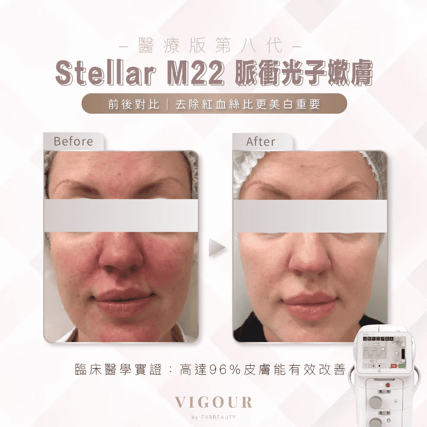 Stellar M22 OPT™治療玫瑰痤瘡