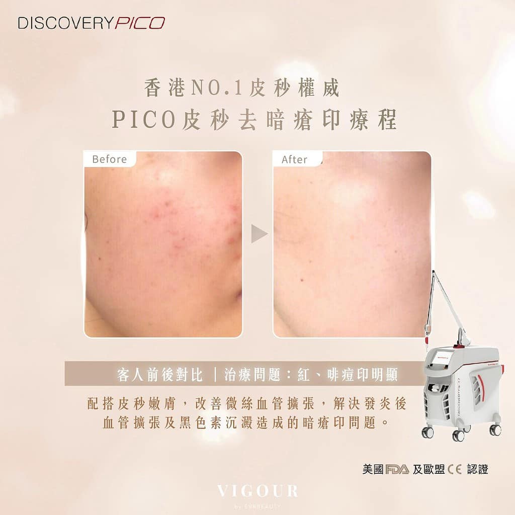 意大利皮秒超跑Discovery PICO®