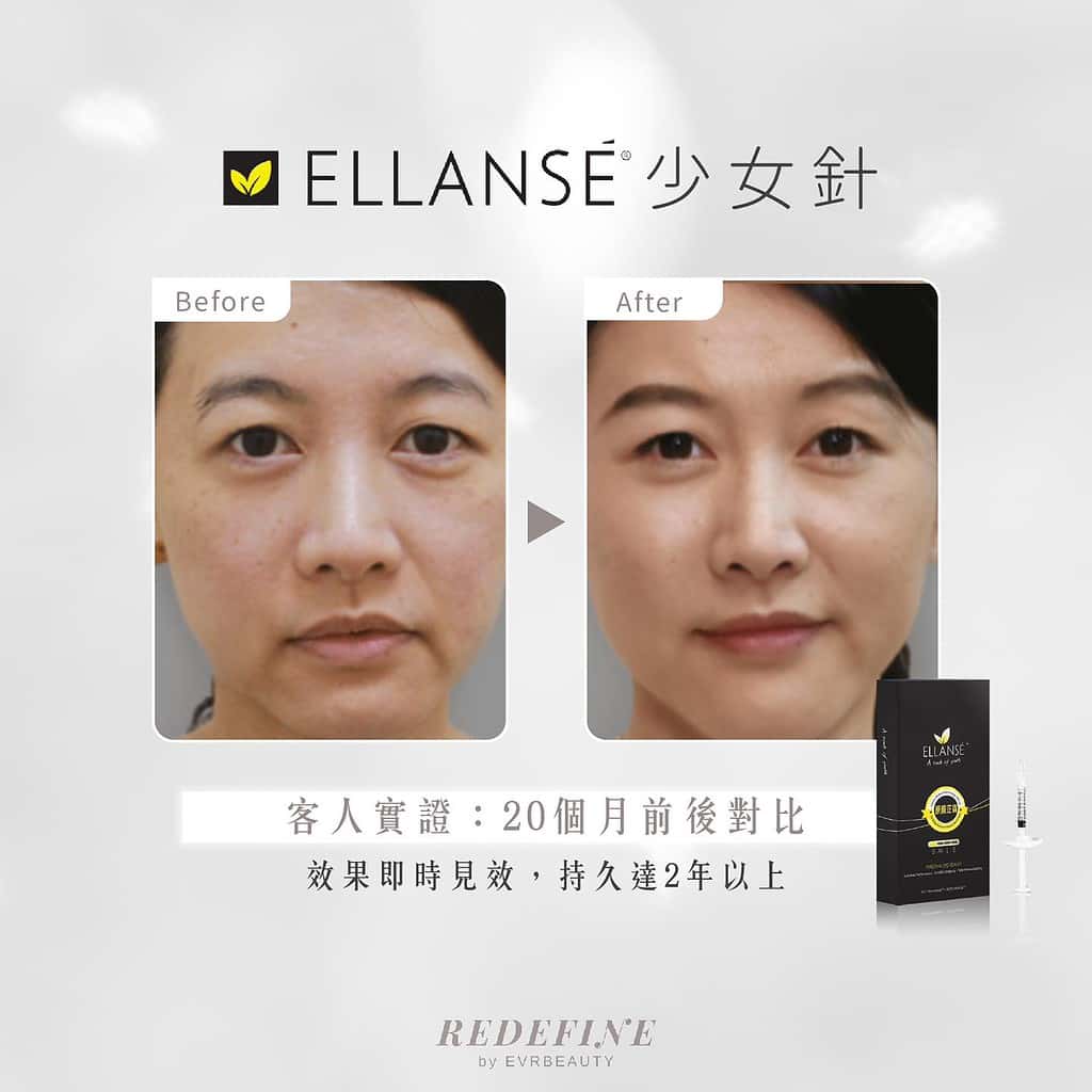 ELLANSE前後對比