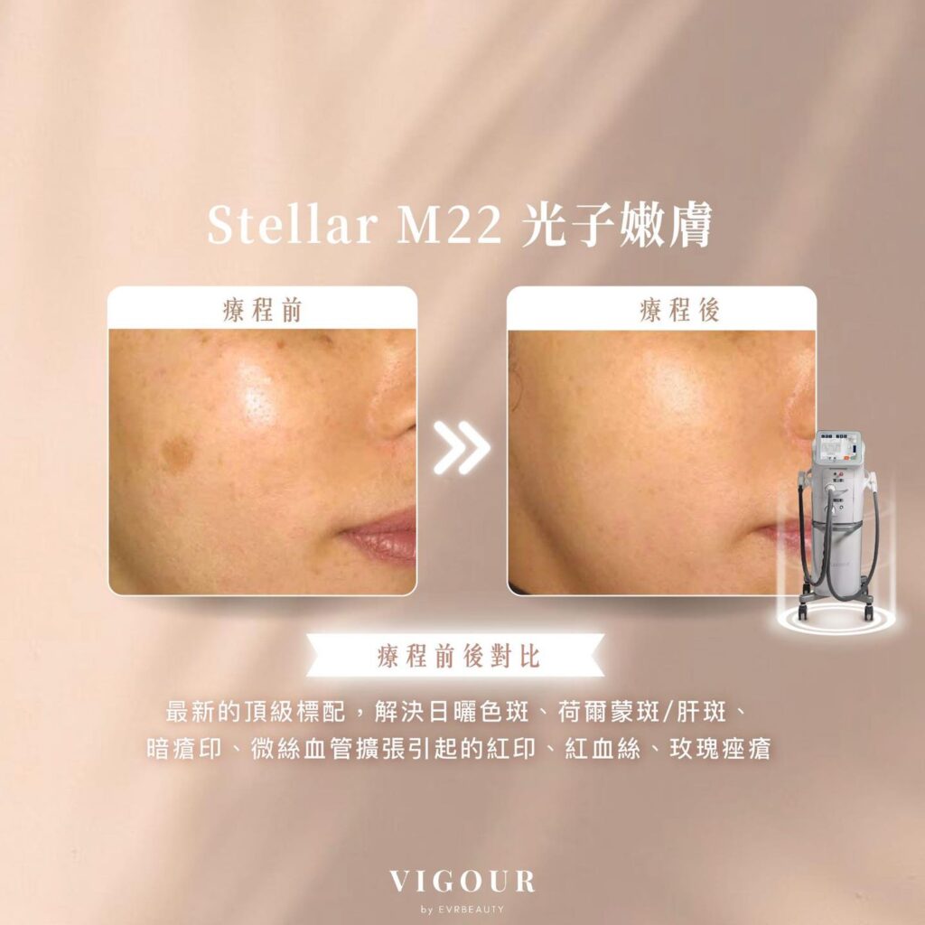 【Stellar M22去邊間？】9款濾片力推4大殺手鐧！Facial不求人攻略篇